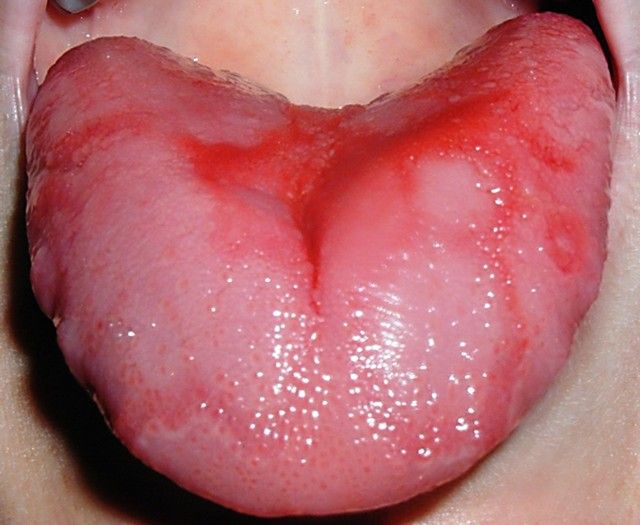 nyelv papillae gyulladás kezelése